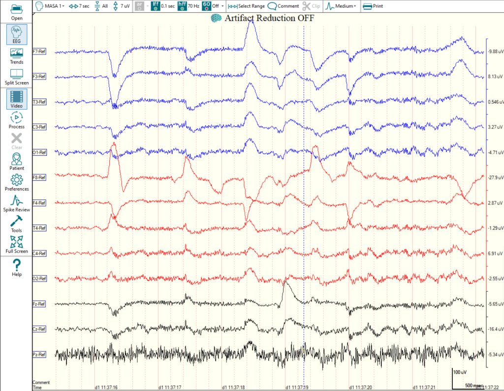 Image of EEG red, blue and black squiggly lines on yellow background. This is the dog looking around, there is a lot of squiggles (noise) on the EEG.