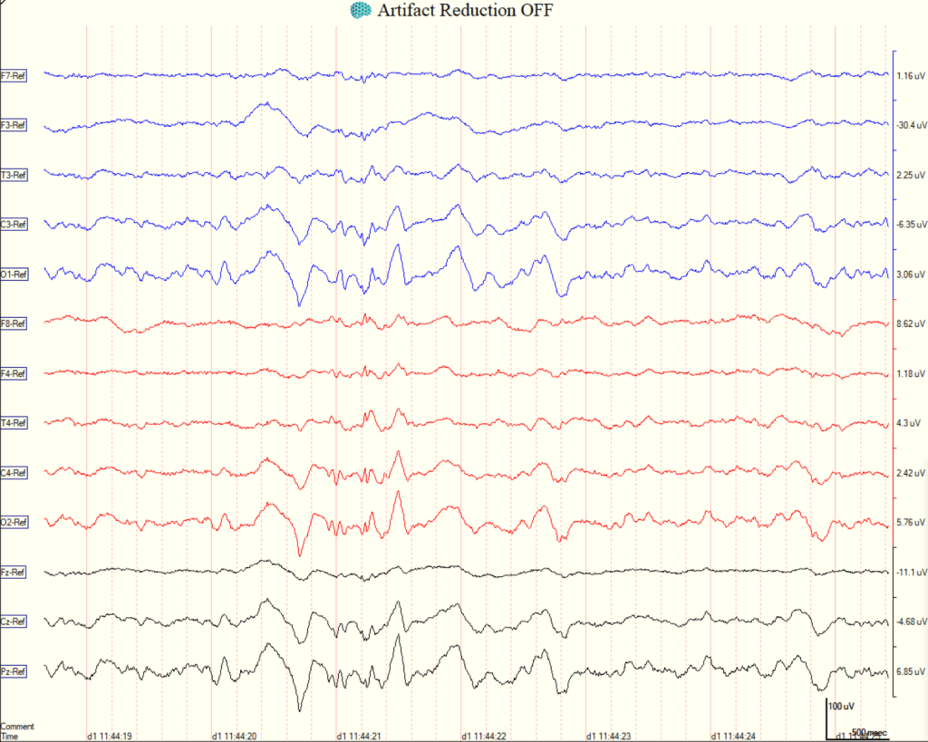 Image of EEG red, blue and black squiggly lines on yellow background. This is a sleeping dog with no EEG (spike-wave) activity.